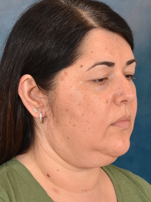 Laser Skin Resurfacing Before & After Gallery - Patient 271506 - Image 3