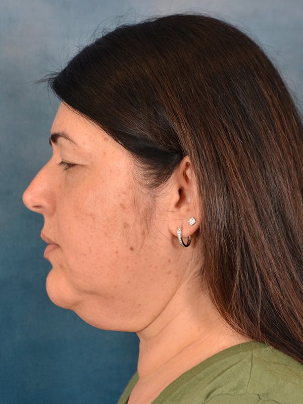 Laser Skin Resurfacing Before & After Gallery - Patient 271506 - Image 9