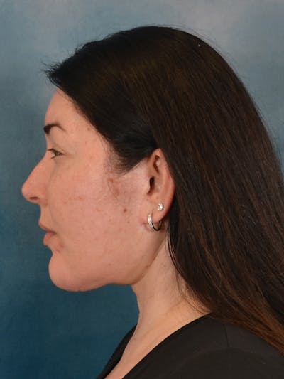 Laser Skin Resurfacing Before & After Gallery - Patient 271506 - Image 10