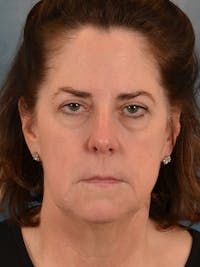 Brow Lift Before & After Gallery - Patient 514948 - Image 1