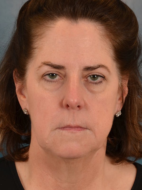 Deep Plane Facelift Before & After Gallery - Patient 290114 - Image 5