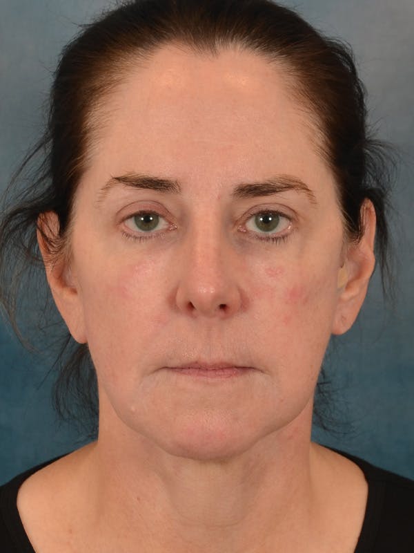 Deep Plane Facelift Before & After Gallery - Patient 290114 - Image 6
