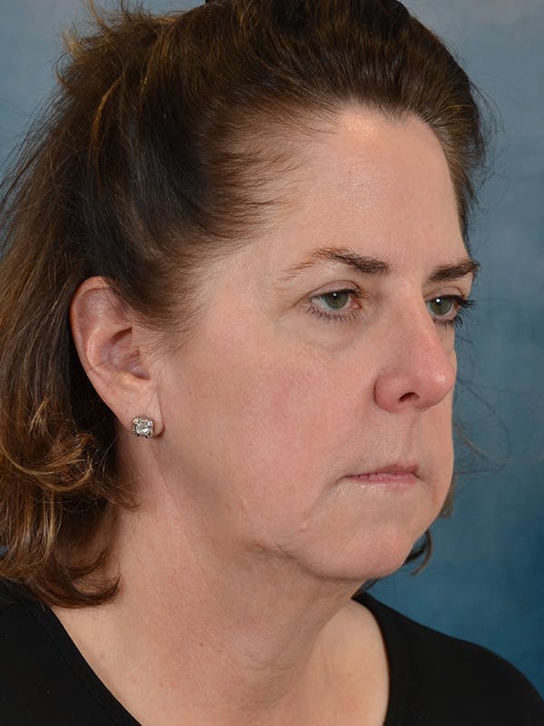 Deep Plane Facelift Before & After Gallery - Patient 290114 - Image 7