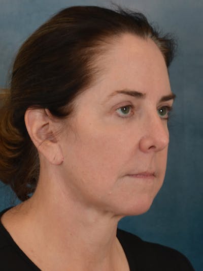 Deep Plane Facelift Before & After Gallery - Patient 290114 - Image 8
