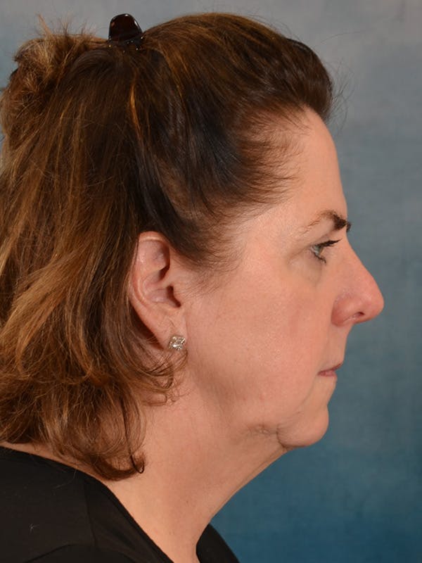 Deep Plane Facelift Before & After Gallery - Patient 290114 - Image 9
