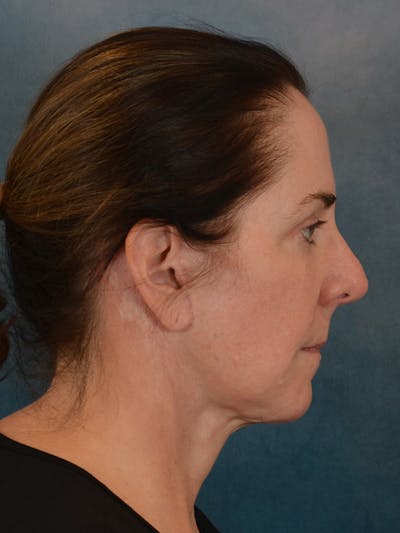 Deep Plane Facelift Before & After Gallery - Patient 290114 - Image 10