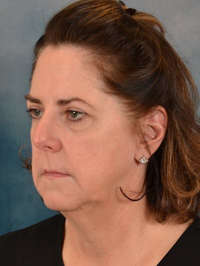 Deep Plane Facelift Before & After Gallery - Patient 290114 - Image 1