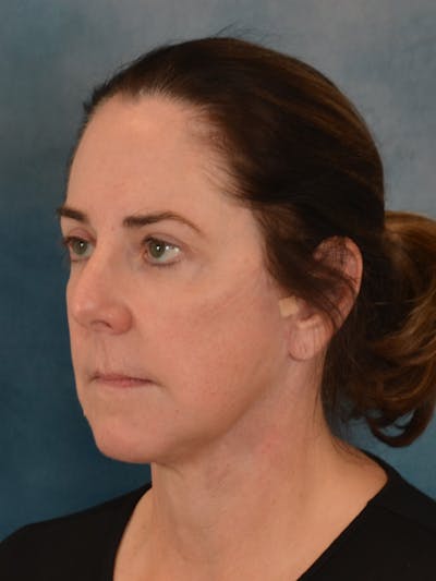 Deep Plane Facelift Before & After Gallery - Patient 290114 - Image 2