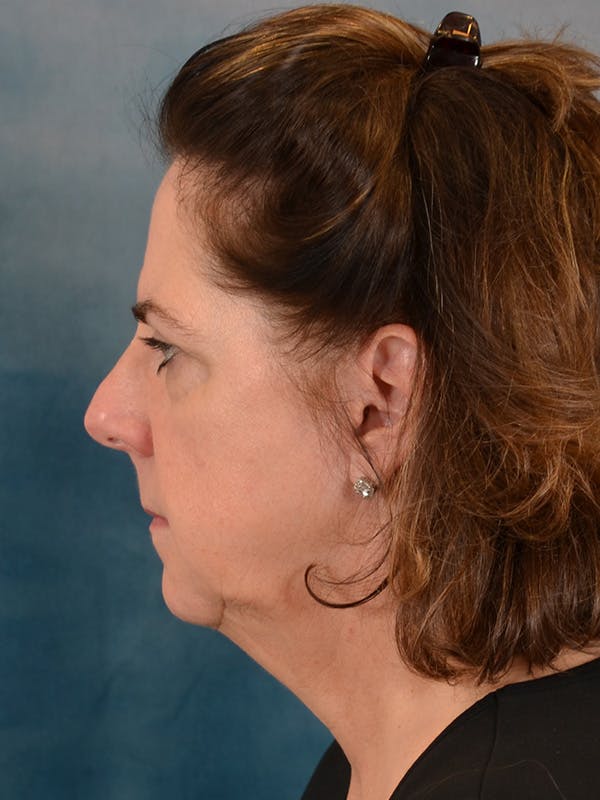 Deep Plane Facelift Before & After Gallery - Patient 290114 - Image 3