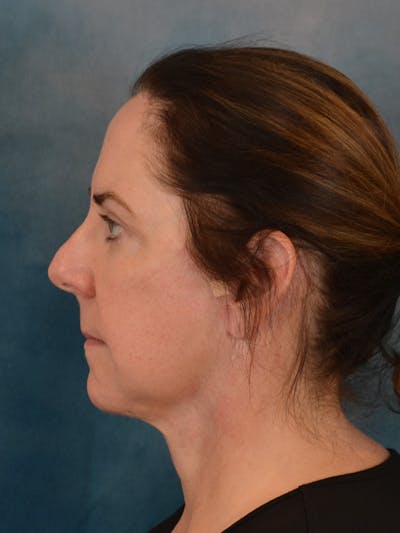 Deep Plane Facelift Before & After Gallery - Patient 290114 - Image 4