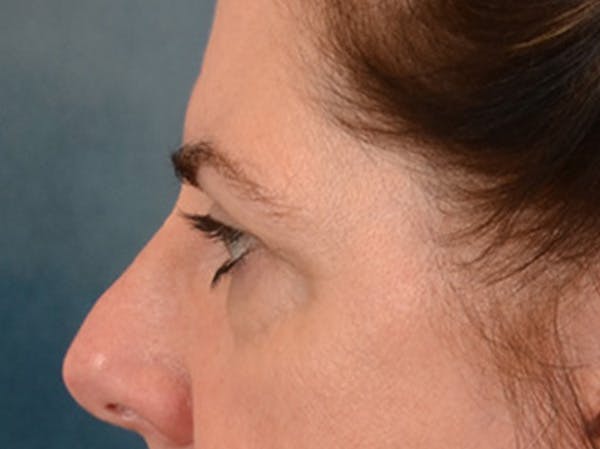 Brow Lift Before & After Gallery - Patient 147461 - Image 9