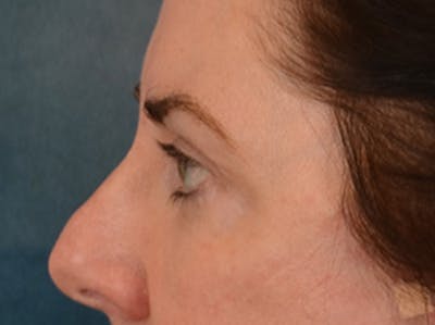 Brow Lift Before & After Gallery - Patient 147461 - Image 10