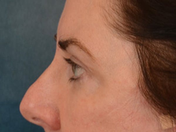 Brow Lift Before & After Gallery - Patient 147461 - Image 10