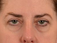Brow Lift Before & After Gallery - Patient 147461 - Image 1