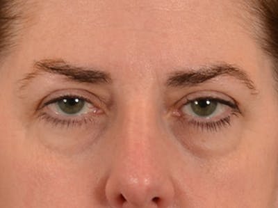 Brow Lift Before & After Gallery - Patient 147461 - Image 1
