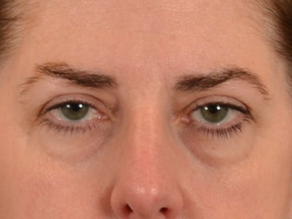 Brow Lift Before & After Gallery - Patient 147461 - Image 1