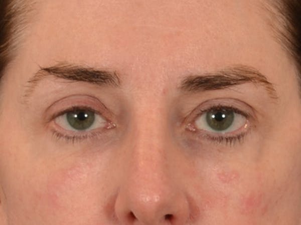 Brow Lift Before & After Gallery - Patient 147461 - Image 2