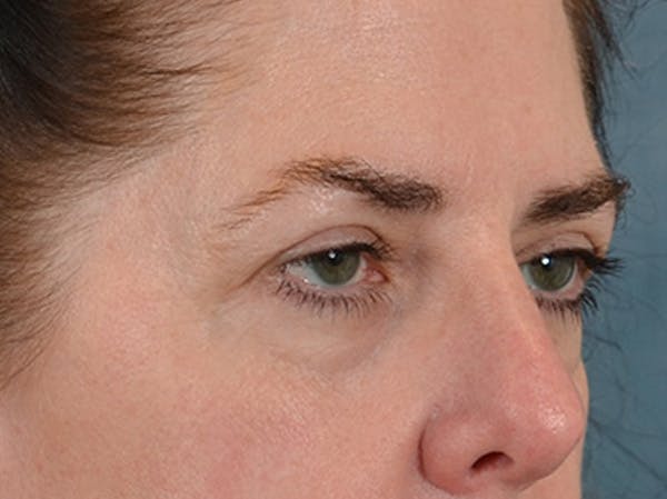 Brow Lift Before & After Gallery - Patient 147461 - Image 3