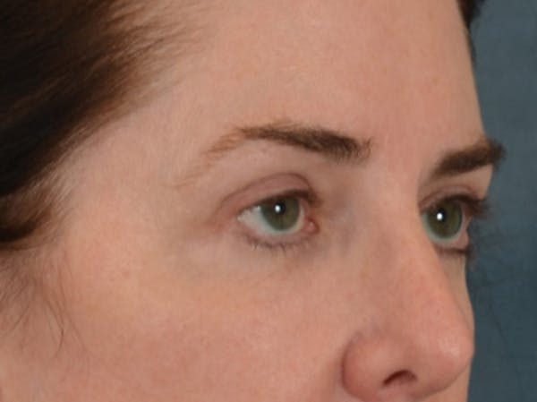 Brow Lift Before & After Gallery - Patient 147461 - Image 4