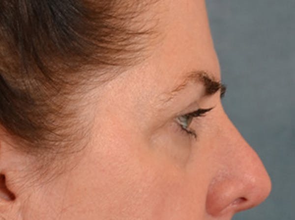 Brow Lift Before & After Gallery - Patient 147461 - Image 5
