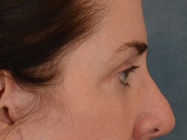 Brow Lift Before & After Gallery - Patient 147461 - Image 6