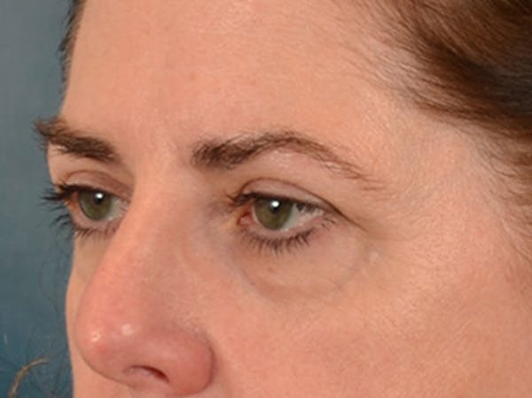 Brow Lift Before & After Gallery - Patient 147461 - Image 7