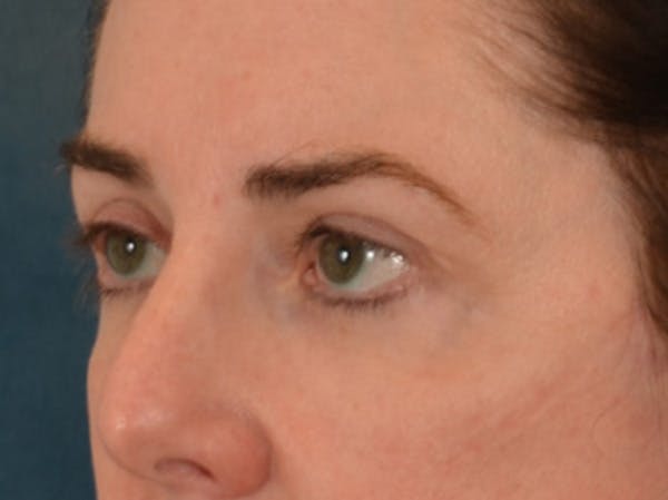 Brow Lift Before & After Gallery - Patient 147461 - Image 8