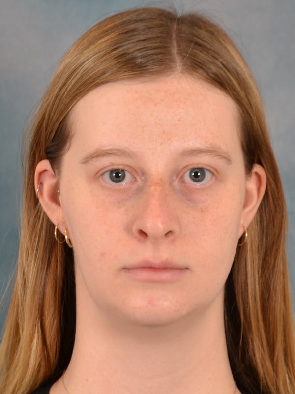 Rhinoplasty Before & After Gallery - Patient 307409 - Image 9