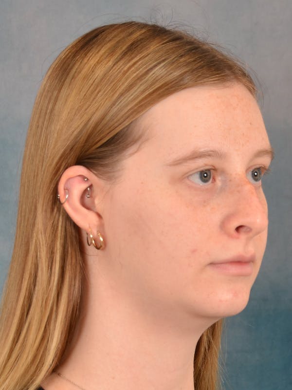 Rhinoplasty Before & After Gallery - Patient 307409 - Image 7