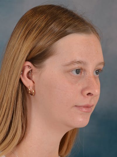 Rhinoplasty Before & After Gallery - Patient 307409 - Image 8