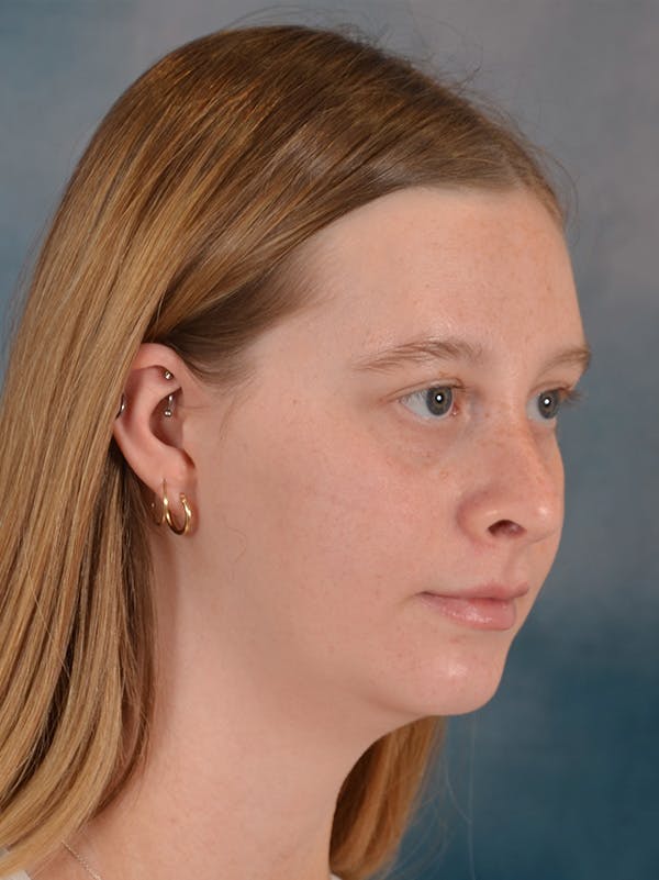 Rhinoplasty Before & After Gallery - Patient 307409 - Image 8