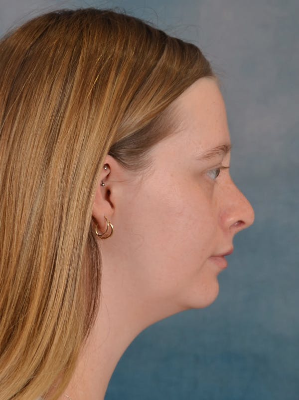 Rhinoplasty Before & After Gallery - Patient 307409 - Image 6
