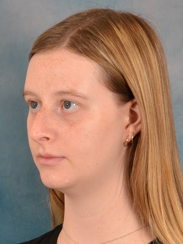 Rhinoplasty Before & After Gallery - Patient 307409 - Image 3