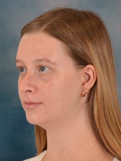 Rhinoplasty Before & After Gallery - Patient 307409 - Image 4