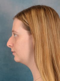 Rhinoplasty Before & After Gallery - Patient 307409 - Image 1