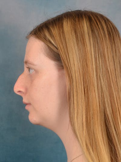 Rhinoplasty Before & After Gallery - Patient 307409 - Image 1