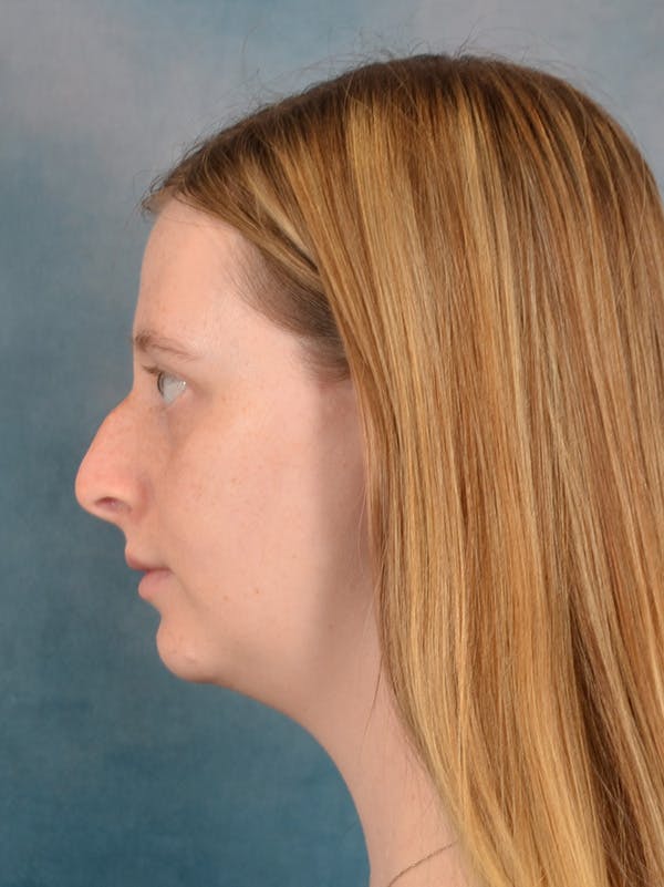 Rhinoplasty Before & After Gallery - Patient 307409 - Image 1