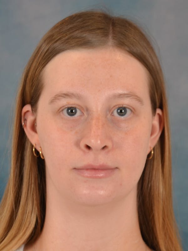 Rhinoplasty Before & After Gallery - Patient 307409 - Image 10