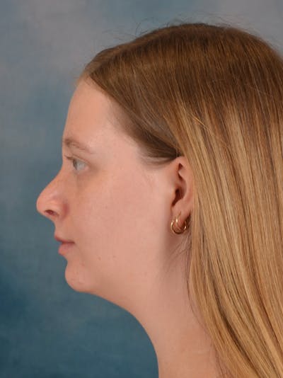 Rhinoplasty Before & After Gallery - Patient 307409 - Image 2