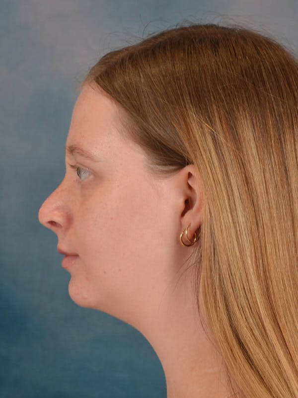 Rhinoplasty Before & After Gallery - Patient 307409 - Image 2
