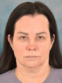 Brow Lift Before & After Gallery - Patient 307627 - Image 1