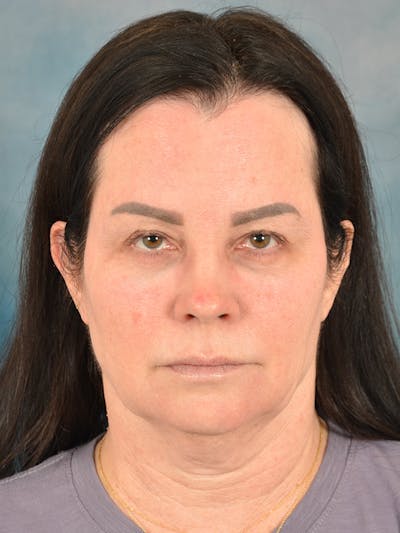 Fat Transfer Before & After Gallery - Patient 131856 - Image 1