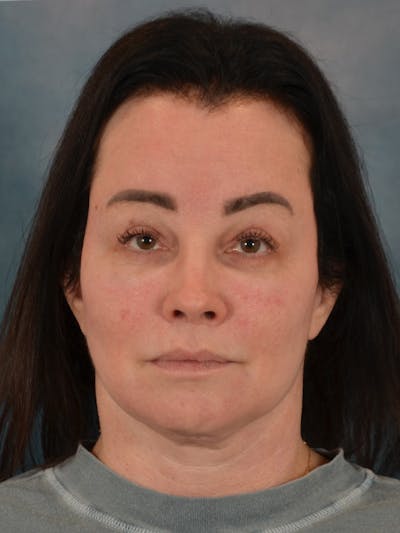 Fat Transfer Before & After Gallery - Patient 131856 - Image 2