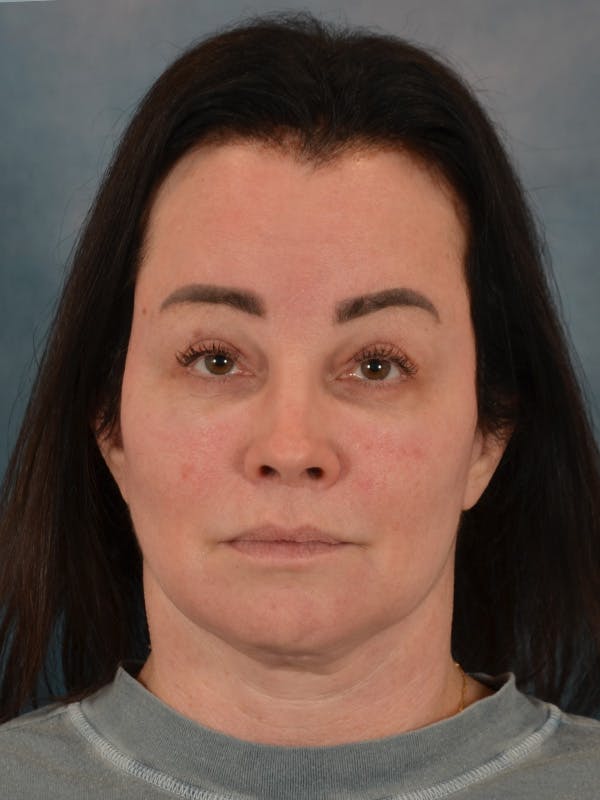 Brow Lift Before & After Gallery - Patient 307627 - Image 2
