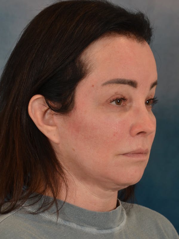 Brow Lift Before & After Gallery - Patient 307627 - Image 8
