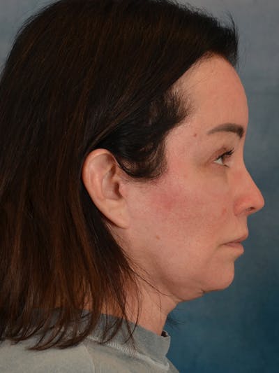 Brow Lift Before & After Gallery - Patient 307627 - Image 10