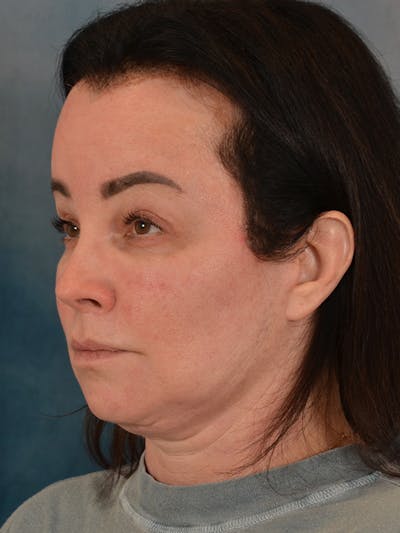 Deep Plane Facelift Before & After Gallery - Patient 178364 - Image 2