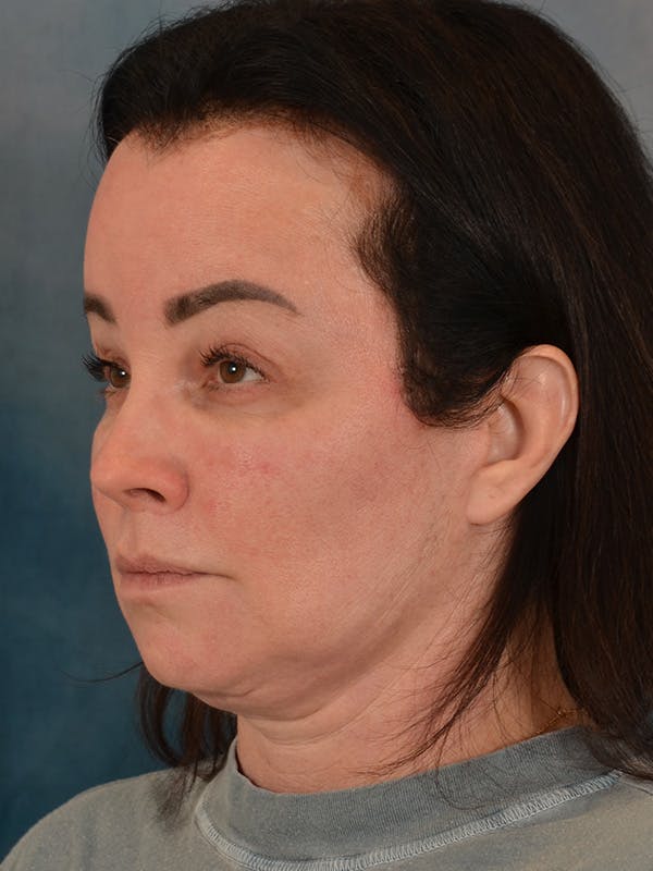 Brow Lift Before & After Gallery - Patient 307627 - Image 4