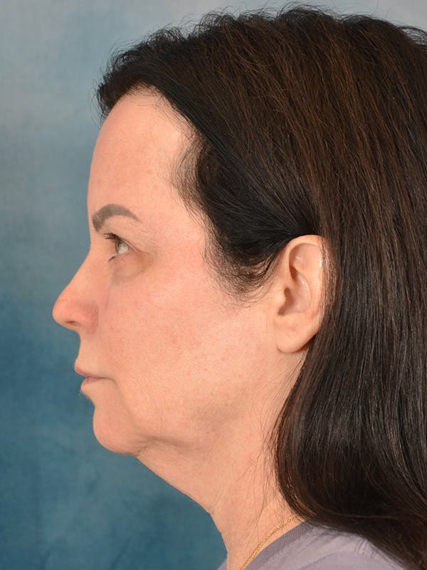 Brow Lift Before & After Gallery - Patient 307627 - Image 5