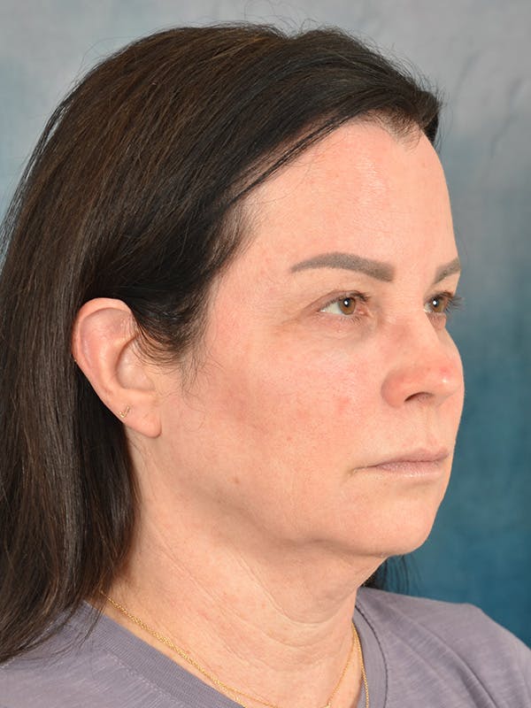 Brow Lift Before & After Gallery - Patient 307627 - Image 7